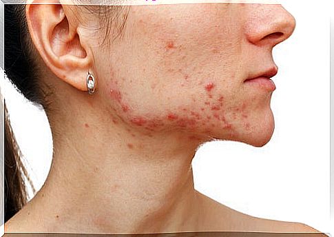 Woman with acne