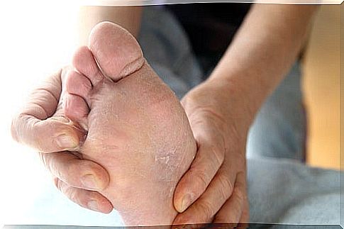 Remedies to naturally treat athlete's foot