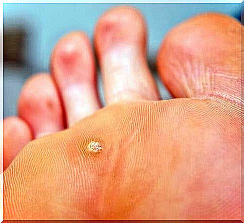 Plantar warts on the sole of the foot