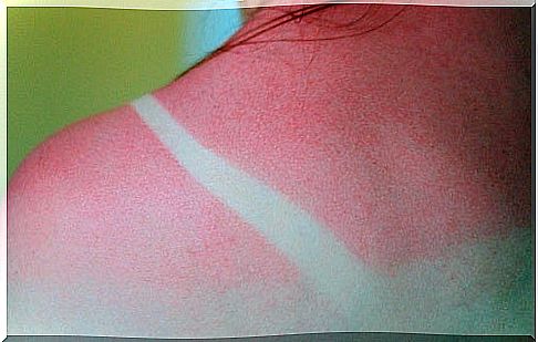 Sun-affected skin