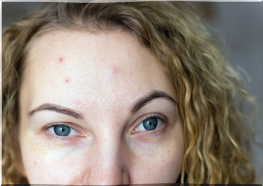 Woman with acne breakout from anxiety.