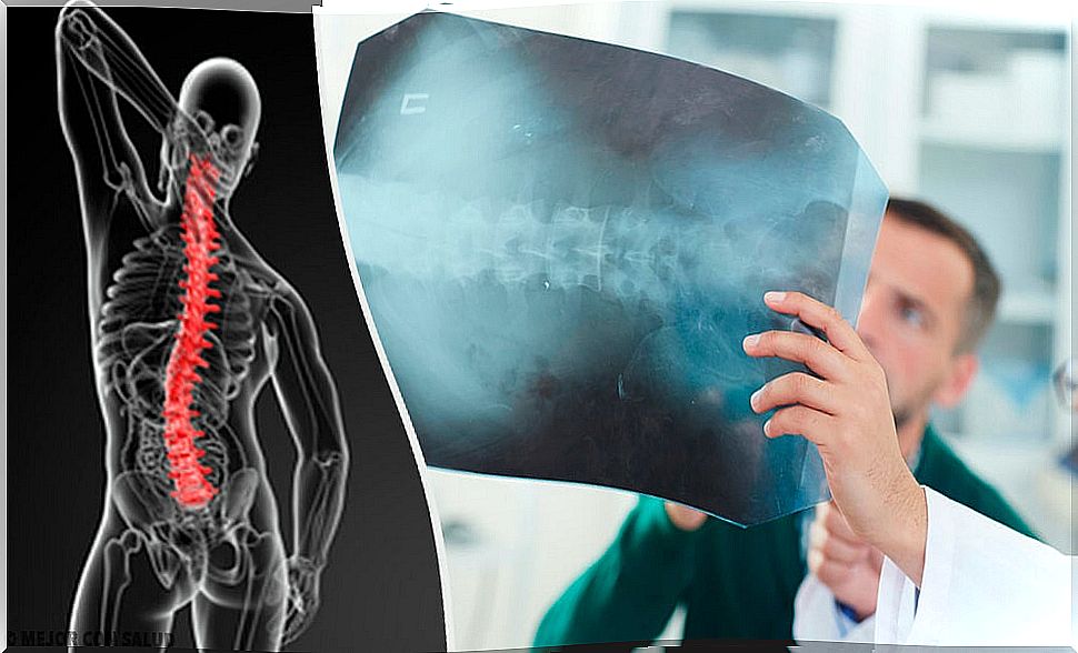 Spinal angiodysgenesis