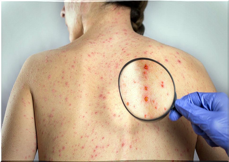 Herpes of the back.